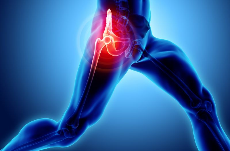 Hip-Bursitis-Sammamish-WA