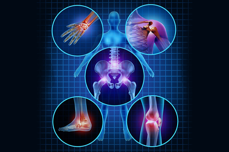 Osteoarthritis-Federal-Way-WA