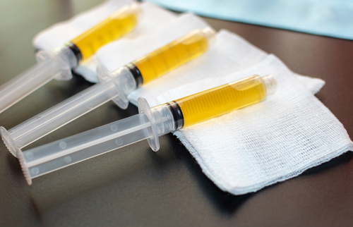 Kent PRP injection Kent PRP injections effectively treat pattern baldness in WA near 98032
